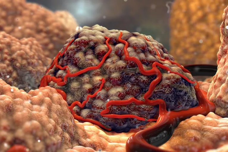 Tumor
